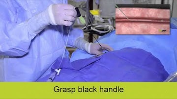 MynxGrip Vascular Closure Device - Live Case