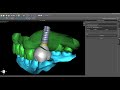 Crown Down Implant Planning and Designing Immediate Restorations Before Surgery