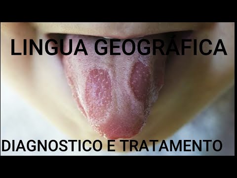 Vídeo: Tratamento Da Glossite Com Remédios E Métodos Populares