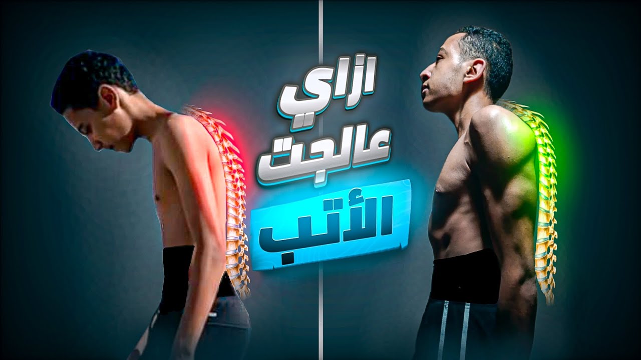 جربت الطريقة الصحيحة لعلاج تقوس الضهر (الأتب)...والنتيجة😱🔥 - YouTube