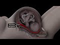 Placental Abruption Explained by a Lawyer