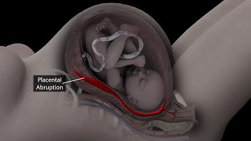Placental Abruption Explained by a Lawyer