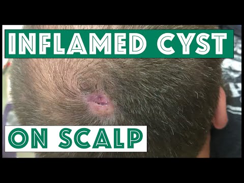 Is This A Cyst On The Scalp?  To Be Continued...