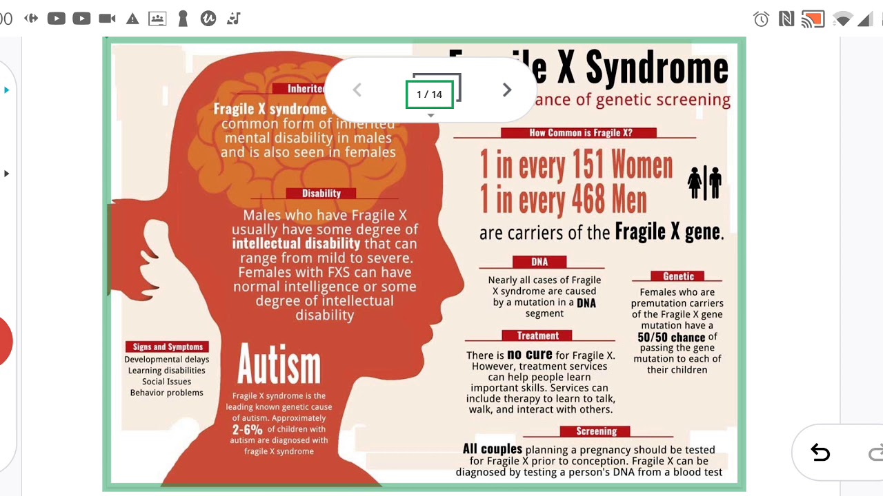 Fragile x syndrome 