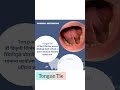 Tongue tie #dentalcrowns #dentaldecay #artist #memes #dentalcap #dentaldisease #dentalesthetics #fun