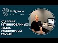 👉 Удаление ретинированных зубов. Клинический случай лечения пациента в Belgravia Dental Studio