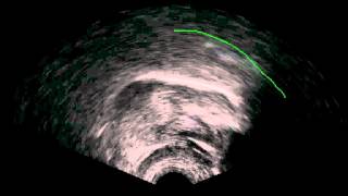Euvular implosive