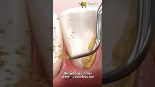 Deep Cleaning Teeth Explained in 30 Seconds 🦷