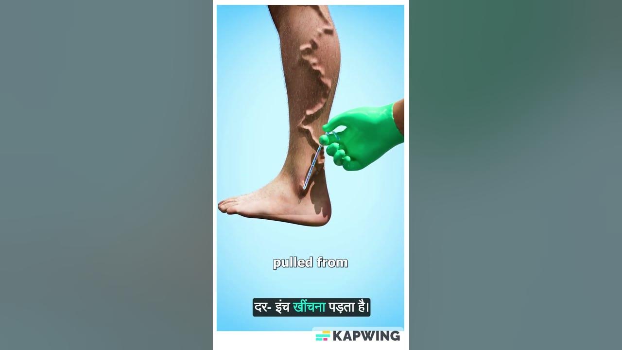 Unraveling the Mystery of Guinea Worm Disease YouTube