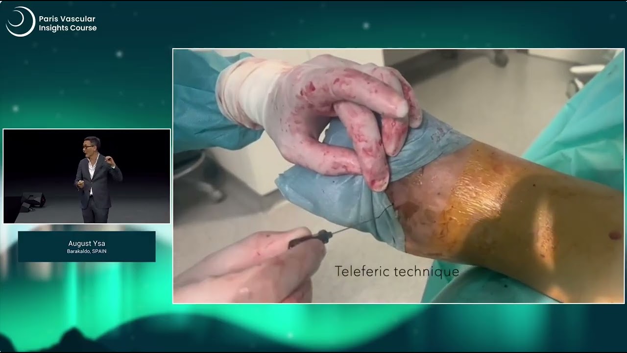 Shockwave IVL: Cracking the barriers of BTK disease.