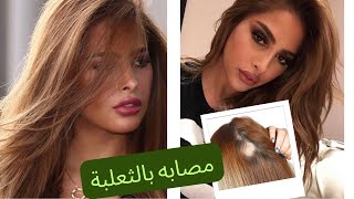 فوز الفهد | انا مصابة بمرض الثعلبة | كيف عالجتها