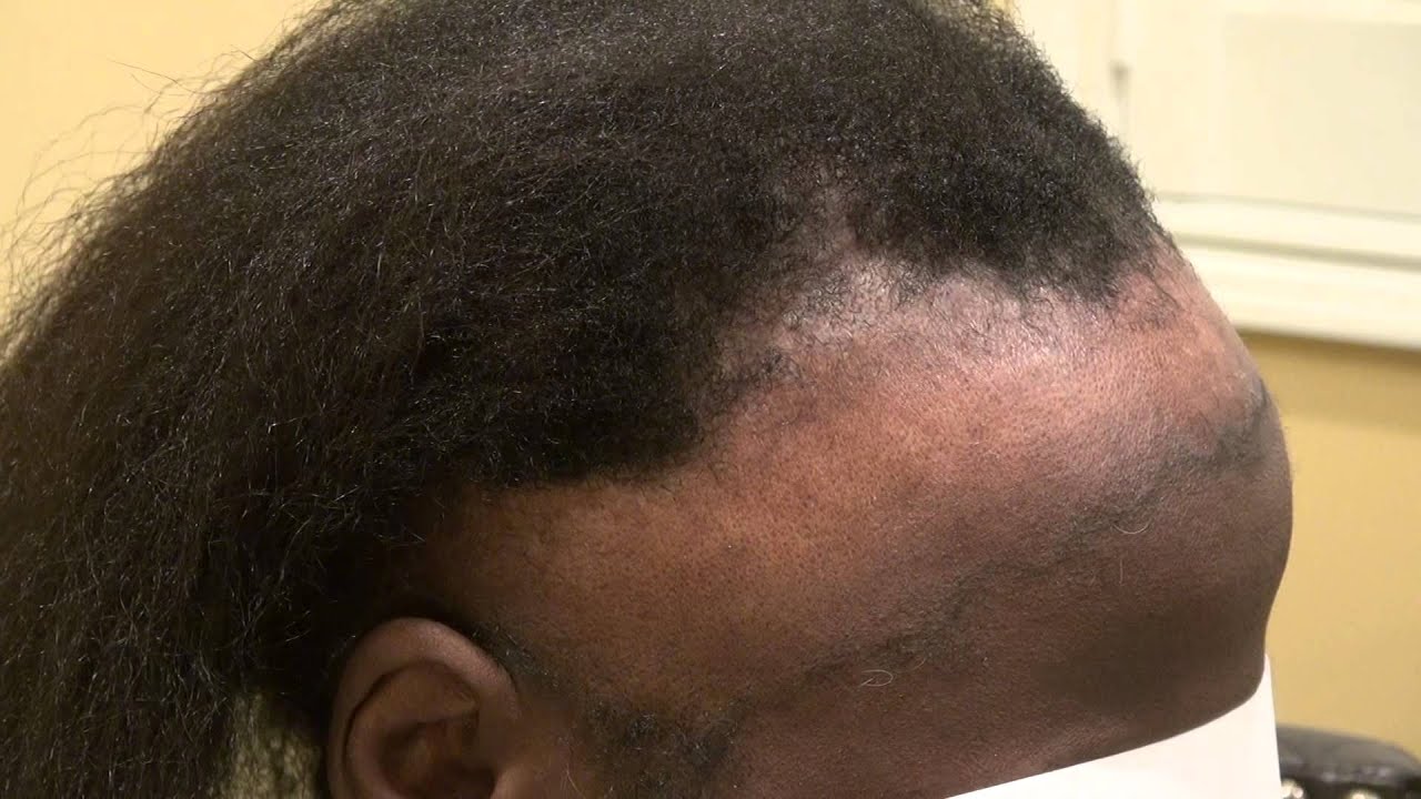 Increase Hair Growth On Forehead: Remedies - Boldsky.com