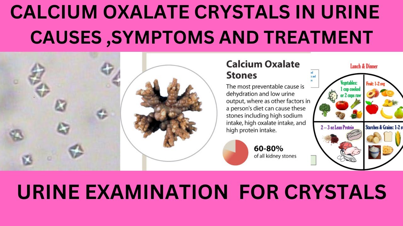 Calcium Oxalate Crystals In Urine Means