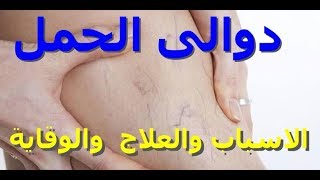 الدوالى فى فترة الحمل وطرق الوقاية ووسائل العلاج الامنه فى الحمل وهل تستمر لما بعد الحمل