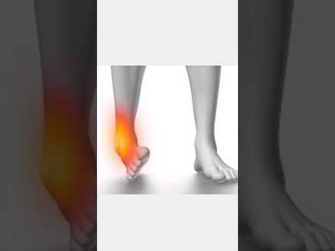 Ankle ligament tear treatment | Grade 1 Ankle Sprain | #viral #shorts | I am Physiotherapist