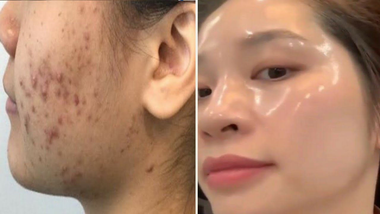 Best Face wash to remove Blackheadswhiteheadacne pimples from face