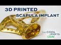 3D Printed Scapula Customized for Patient: The Cool Parts Show #25