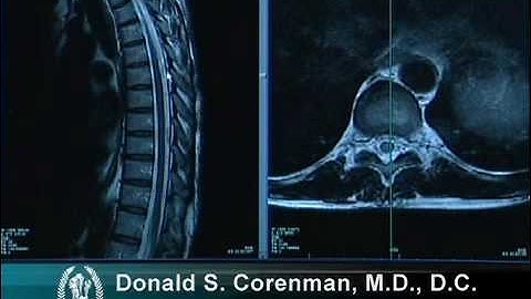 How to Read a MRI of the Normal Thoracic Spine (Mid Back) | Vail Spine Specialist