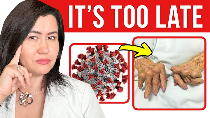 Can COVID-19 Causes Autoimmune Diseases? The TRUTH explained by a Rheumatologist
