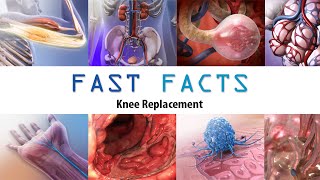 Knee Replacement: Visible Body Fast Facts