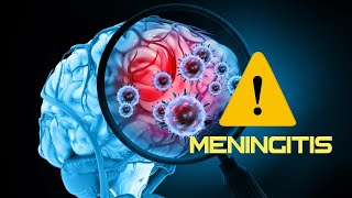 Meningitis: Una Amenaza Persistente en el Mundo Moderno