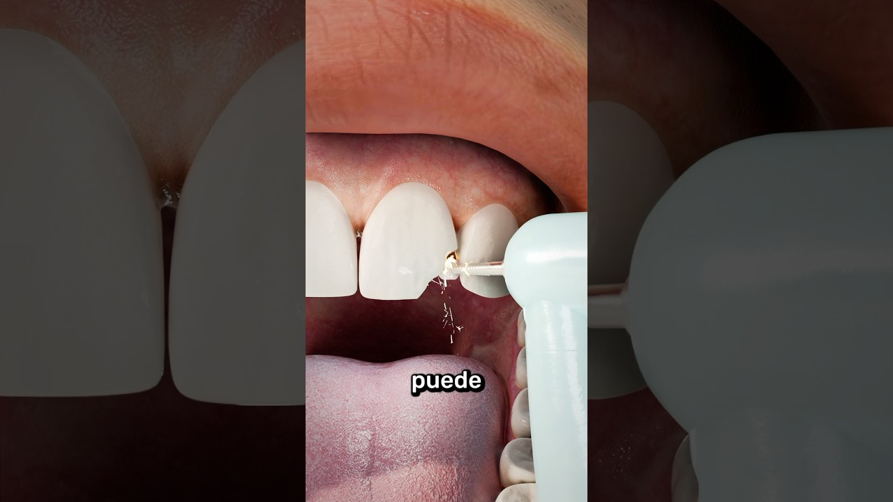 Cómo Arreglar Un Diente Roto 🦷