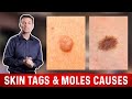 What Causes Skin Tags and Moles? – Dr.Berg