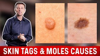 What Causes Skin Tags And Moles? Dr.berg