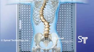Right Thoracic Curve Scoliosis Providence Nocturnal Scoliosis® System
