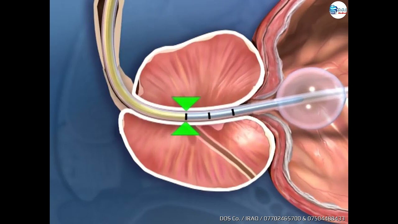 Д простату. Трансуретральная резекция простаты. Трансуретральная резекция ДГПЖ. Трансуретральная резекция аденомы простаты. Термотерапия предстательной железы.