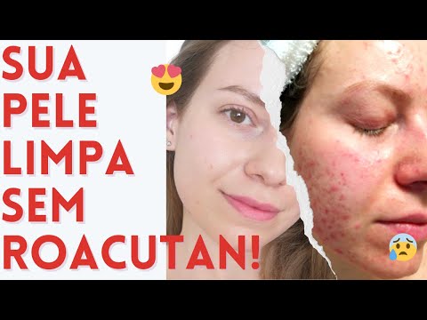 7 Opções de Tratamento Tópico da ACNE | Eliminar a acne sem Roacutan e sem Anticoncepcional