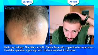 شهادة مريضنا السعيد بعد سنة على عملية زراعة الشعر  |  Dr. Bayer Clinics