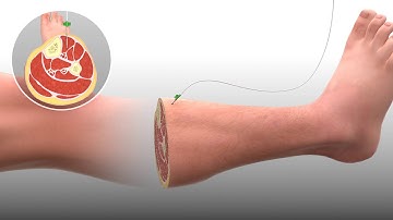 Millar Mikro-Cath Compartment Pressure