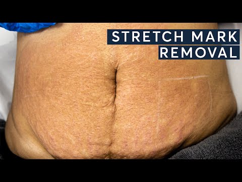 Stetch Mark Removal