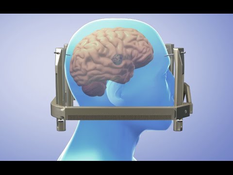 Video Gamma Knife Treatment