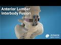 Anterior Lumbar Interbody Fusion (ALIF)