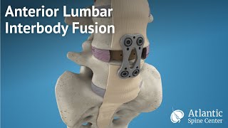 Anterior Lumbar Interbody Fusion (ALIF)