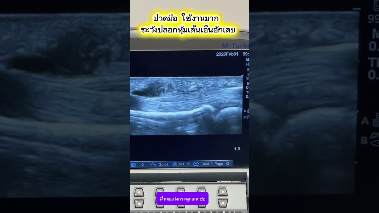 ปวดมือ ใช้งานมาก ระวังปลอกหุ้มเส้นเอ็นอักเสบ