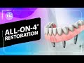 All-on-4® Restoration (3D Animation)