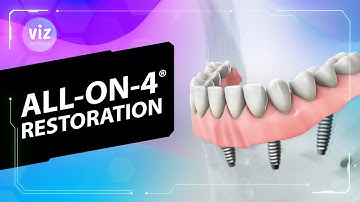 All-on-4® Restauratie (3D-animatie)