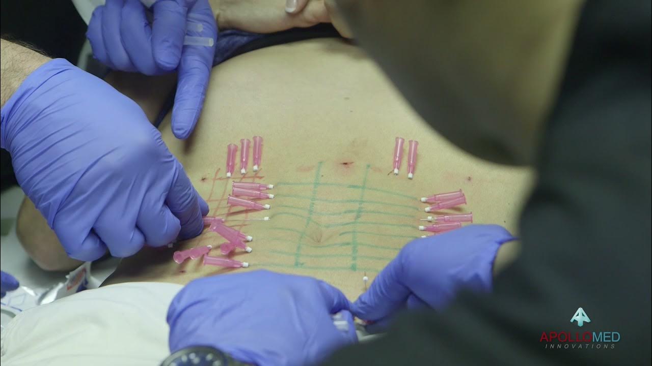 PDO thread lift/Stomach YouTube