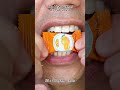 Most Satisfying Candy & Chocolate ASMR 🍫🍬 #DoctorTristanPeh #ASMR