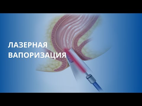 Лазерная вапоризация