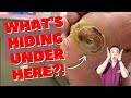 You'll NEVER Guess What's Hiding Inside - THICK Diabetic Ulcer Removal | Dr. Kim