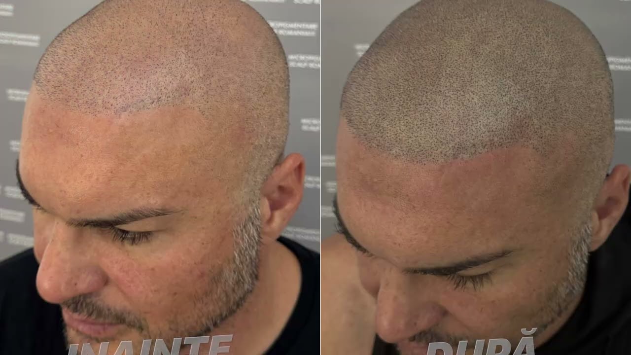 Andy Popescu vorbește despre Micropigmentare Scalp Romania