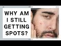 10 Reasons Your Still Getting Spots As An Adult?! Adult Acne - Causes Of Acne ✖ James Welsh