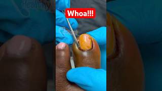 TOE NAIL POPS ALL OVER DOCTOR popping satisfying