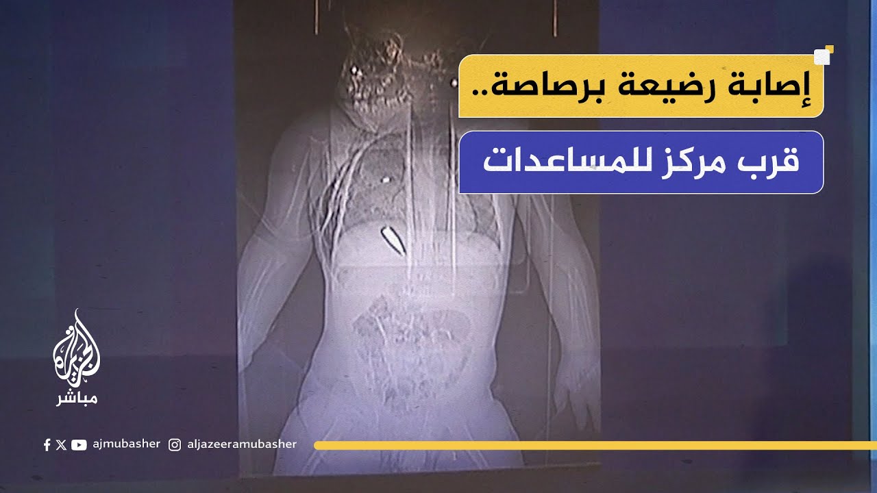أصيبت بالقرب من مركز لتوزيع المساعدات.. طبيب يفند الشكوك في أشعة طبية لطفلة من قطاع غزة