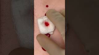 Gunshot Wound First Aid Using Candy Wrapper 🍬 #apocalypse #survivalskill #goodtoknow #vet #medicine