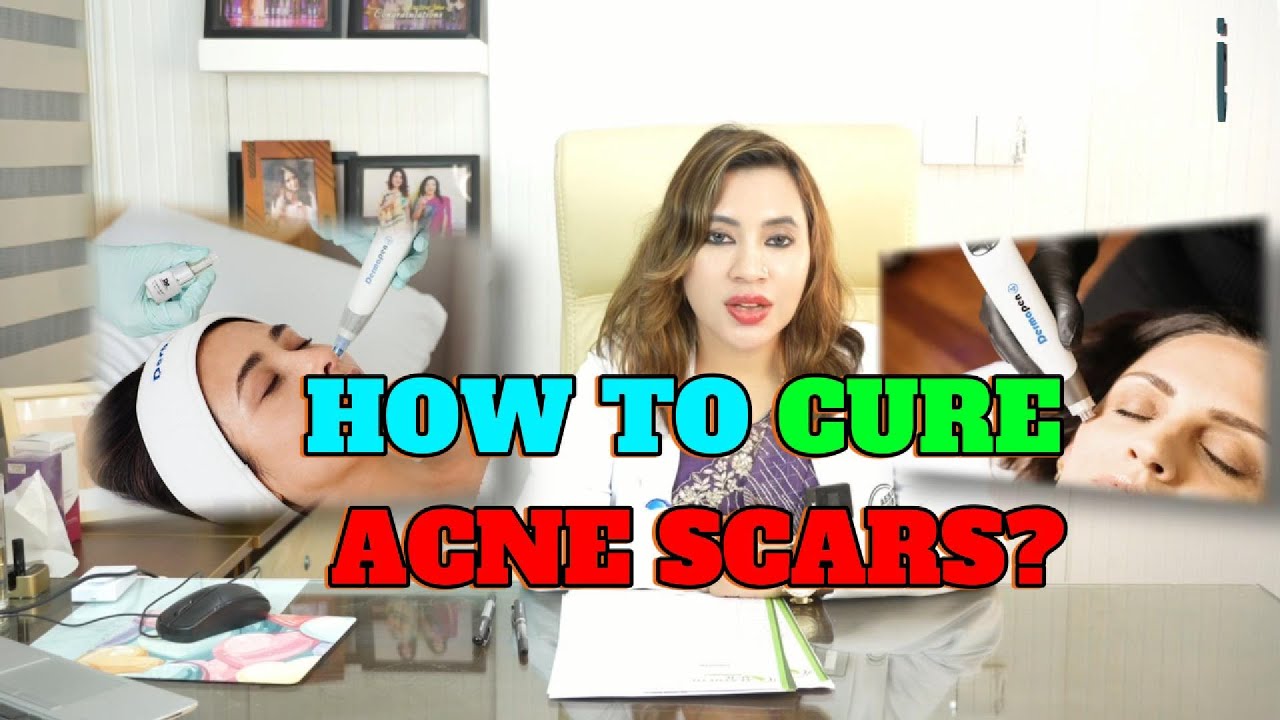 How To Cure Acne Scar? | Dr. Israt Jahan | Best Dermatologist in Bangladesh |